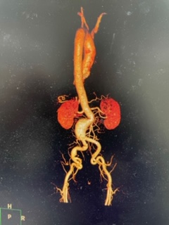 aneyrysma-koiliakis-aortis-endaggeiaki-antimetopisi